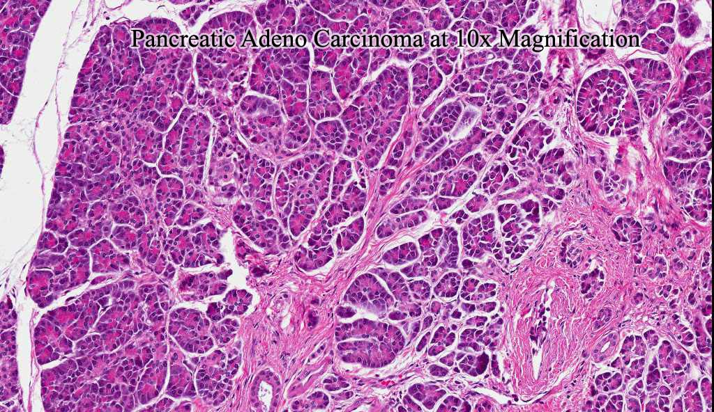 Pancreatic Adeno Carcinoma at 10x Magnification